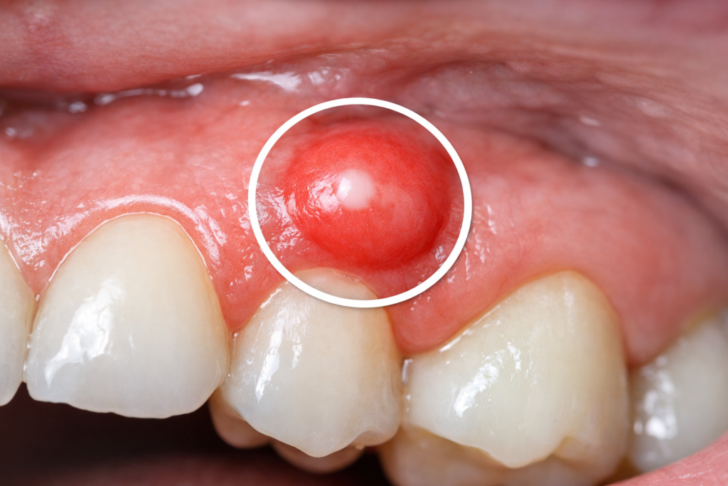 Bump on Gums
